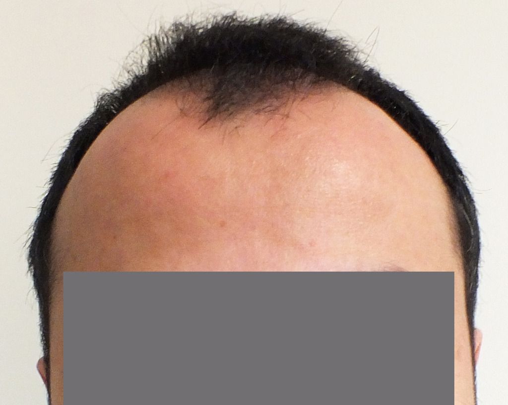 Dr Ekrem Civas 3350 Grafts Fue 10 Months